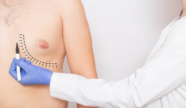 The doctor, plastic surgeon, marks with a marker the mark of a surgical operation to reduce fat on the male breast. Gynecomastia modern procedure concept, liposuction