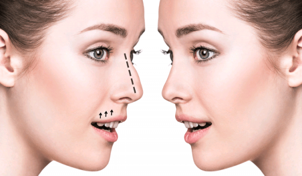 rinoplastia-cirurgia-nariz-